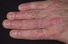 Psoriatic patches on the hands