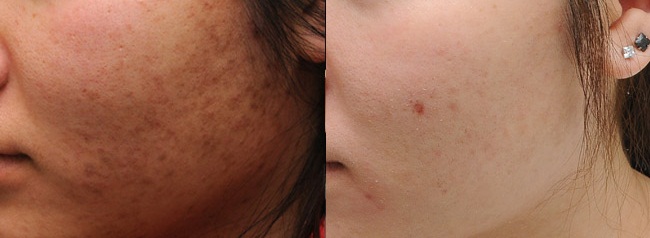 Skin Whitening &amp; Skin Lightening – Latest advances Dr. Rinky 
